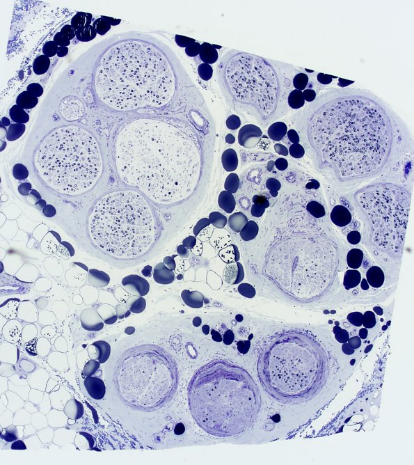 9A1 Perineuritis, idiopathic (Case 9) Plastic 1