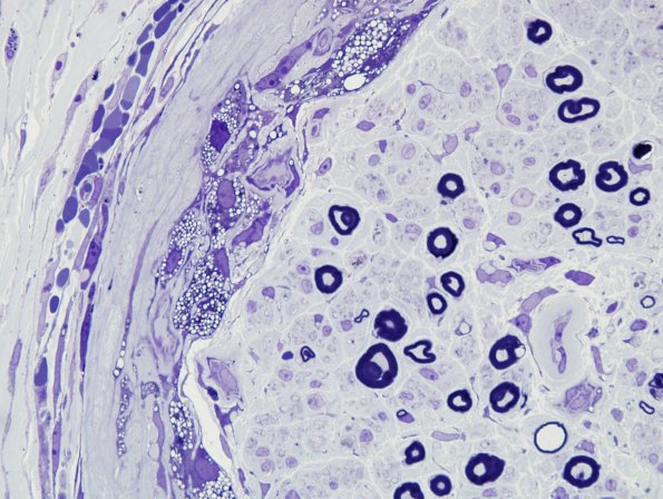 9A2B Perineuritis (Case 9) Plastic 1.jpg