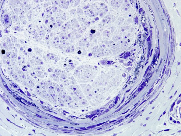 9A3B Perineuritis, idiopathic (Case 9) Plastic 8