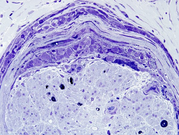9A4B Perineuritis, idiopathic (Case 9) Plastic 9