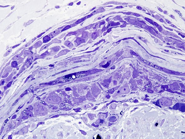 9A4C Perineuritis, idiopathic (Case 9) Plastic 13