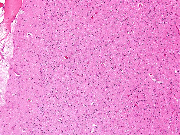 11A3 CJD, (Case 11) H&E occipital cortex 10X.jpg