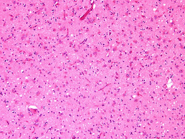 11A4 CJD, (Case 11) H&E occipital cortex 20X.jpg