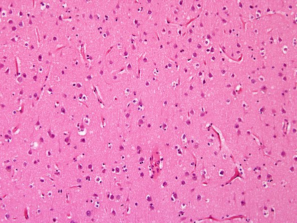 11A7 CJD, (Case 11) H&E frontal cortex 20X.jpg