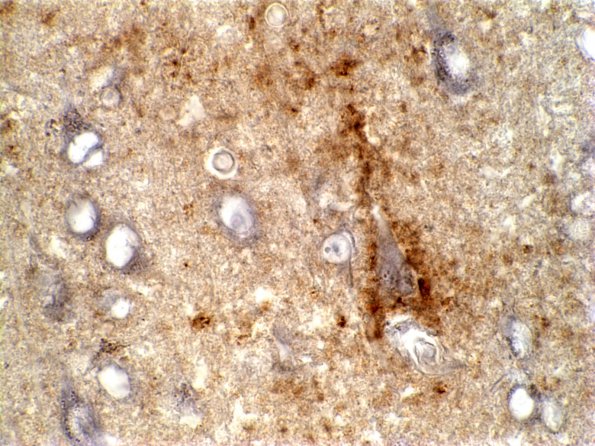 13B2 CJD (Case 13) 1 PrpImmuno