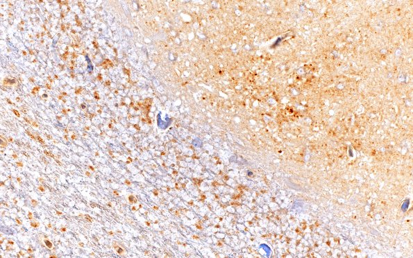 13D3 CJD (Case 13) 1 PrpImmuno Cbell 40X 2