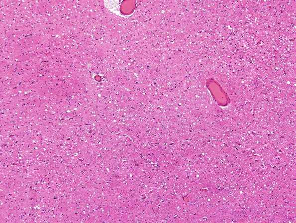 14B1 CJD (Case 14) Basal Ganglia H&E 2