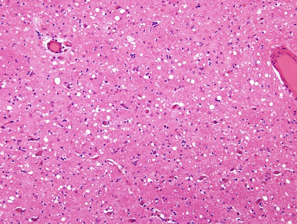 14B2 CJD (Case 14) Basal Ganglia H&E 1