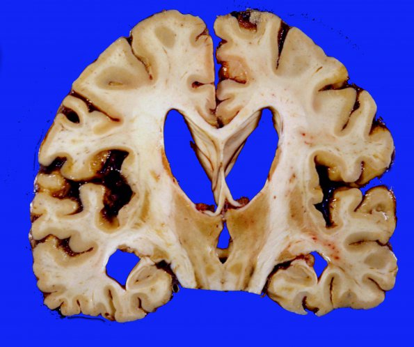 15A3 CJD (Case 15)  3 extended survival