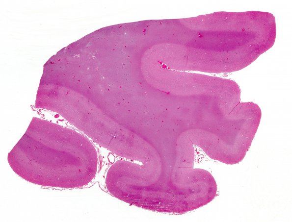 16B1 CJD (Case 16) H&E whole mount