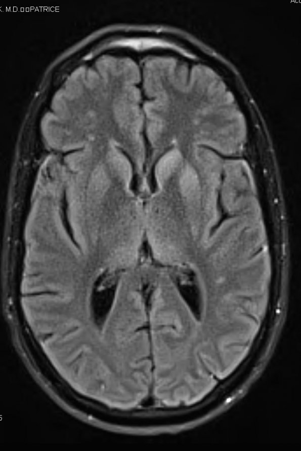 17A1 CJD (Case 17) FLAIR - Copy