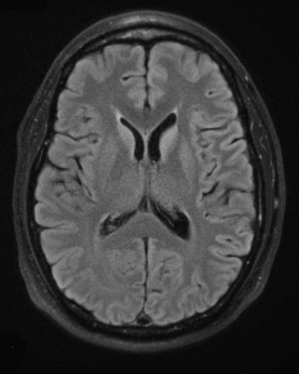 18A1 CJD (Case 18) TIRM BLADE - Copy