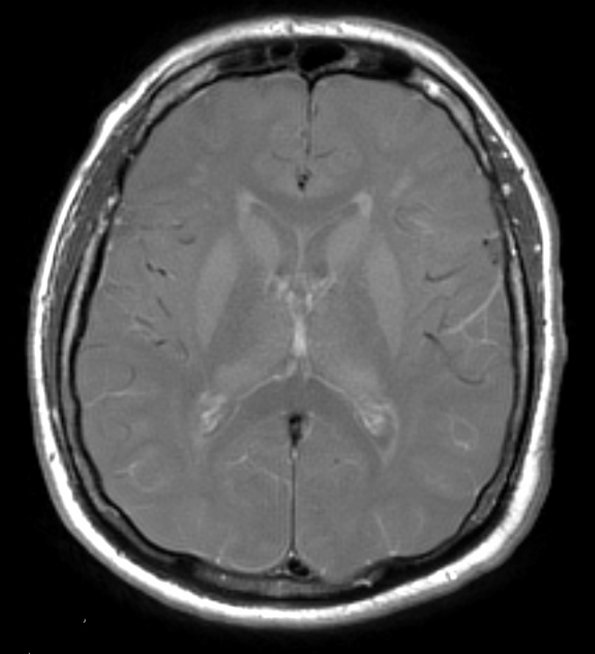 19A2 CJD (Case 19) T1 W - Copy