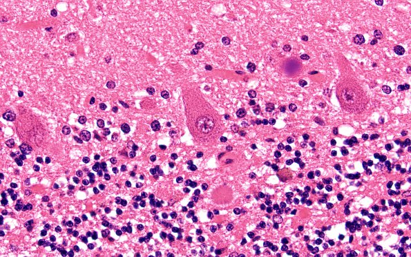 19B2 (Case 19) H&E 60X 3