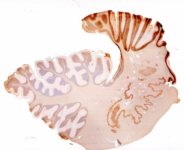 19C1 CJD (Case 19) PRP whole mount