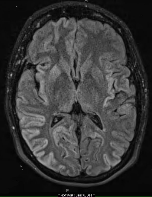 1A1 CJD (Case 1) T2 FLAIR (2) - Copy - Copy