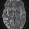 1A3 CJD (Case 1) DIFFUSION ADC 2 (2) - Copy