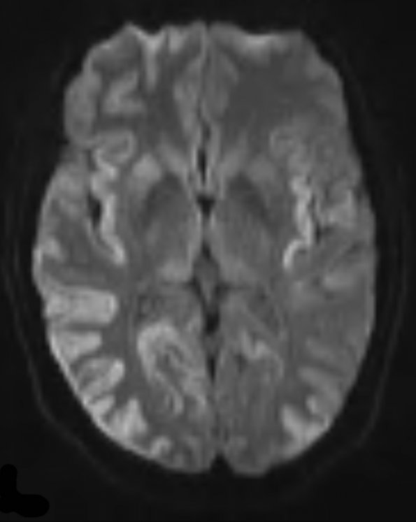 1A3 CJD (Case 1) DIFFUSION ADC 2 (2) - Copy