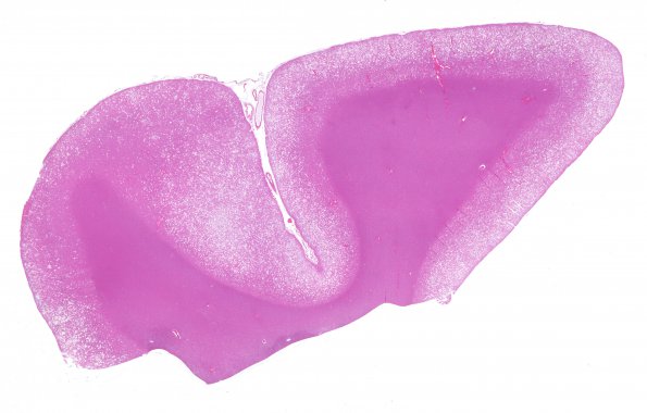 1C1 CJD (Case 1) Temporal cortex H&E whole mount 1A