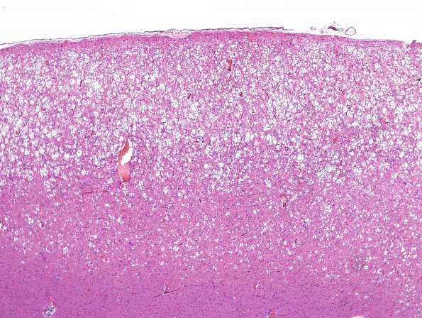 1C2 CJD (Case 1) Cortex H&E 6