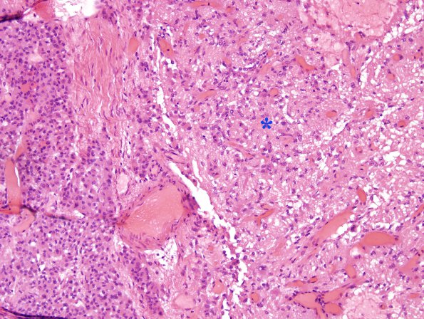 1E CJD (Case 1) pituitary H&E copy