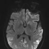 21A1 CJD (Case 21) diffusion-trace slice 35 - Copy