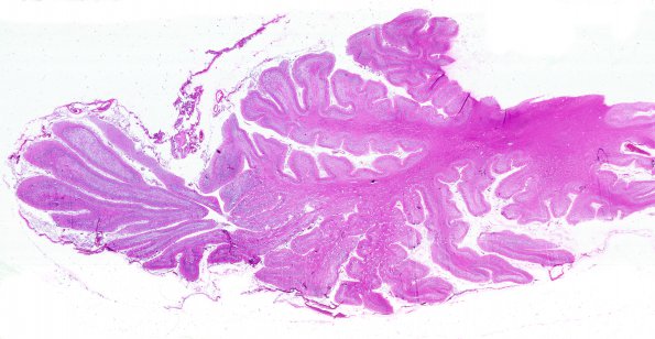 22C1 CJD (Case 22) H&E O WM