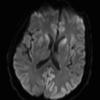 23A1 CJD (Case 22) diffusion-trace slice 15