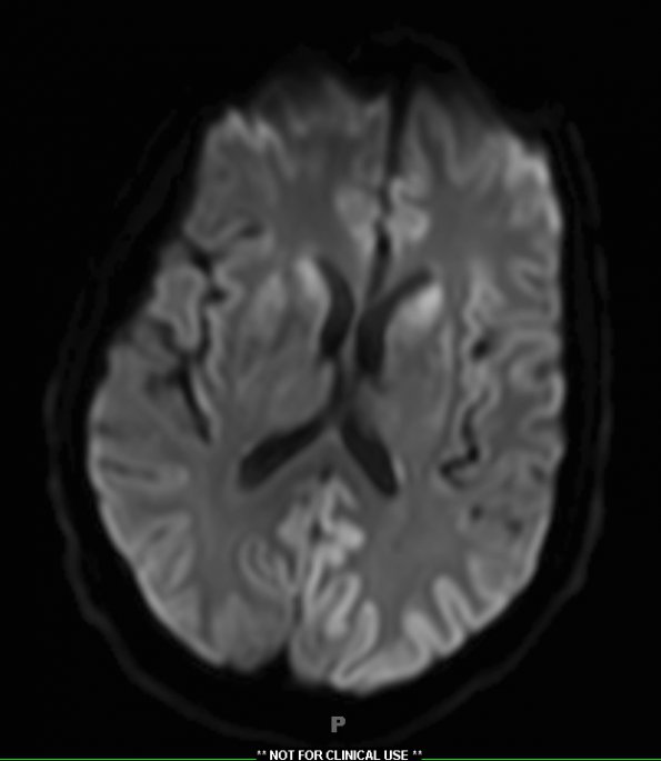 23A1 CJD (Case 22) diffusion-trace slice 15