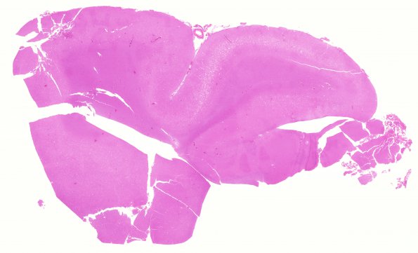 23B1 CJD (Case 23) H&E whole mount Occipital