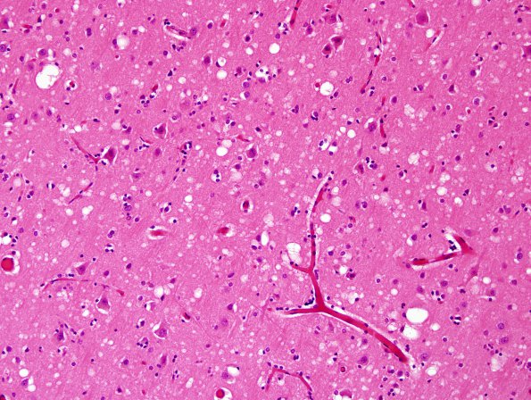 23B2 CJD (Western blot, Case 23) Frontal Cortex H&E 1.jpg