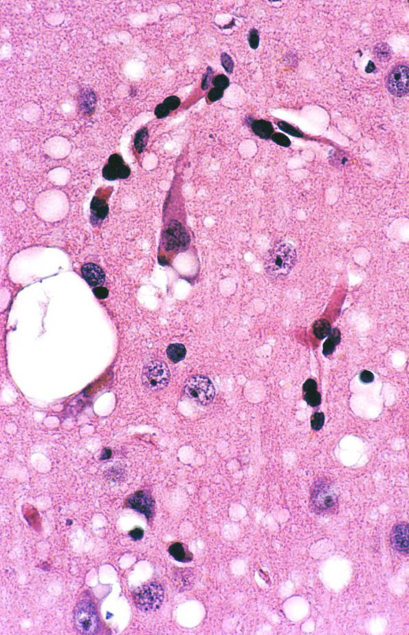 27A1 Spongiform change, CJD 2