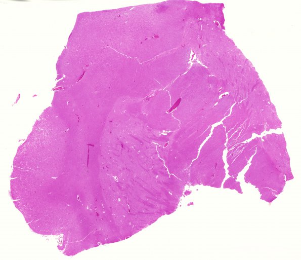 2B1 CJD (Case 2) H&E whole mount 1