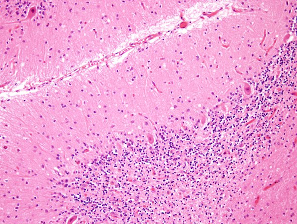 2C2 CJD (Case 2) H&E CBell 1