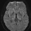3A3 CJD (Case 3) DIFFUSION ADC - Copy