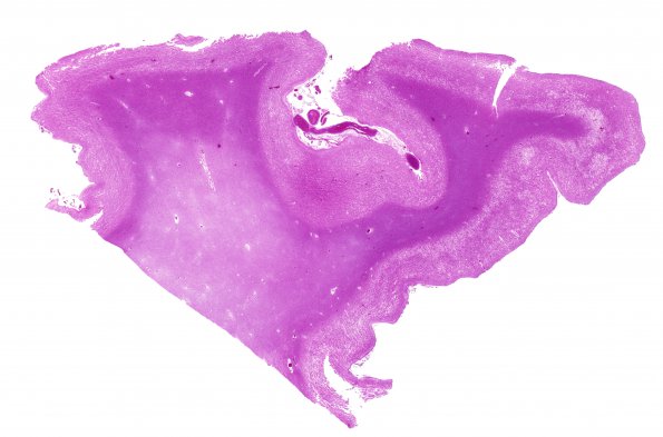 4C1 CJD, 5 yr Hx PrP proven (Case 4) whole mount 2