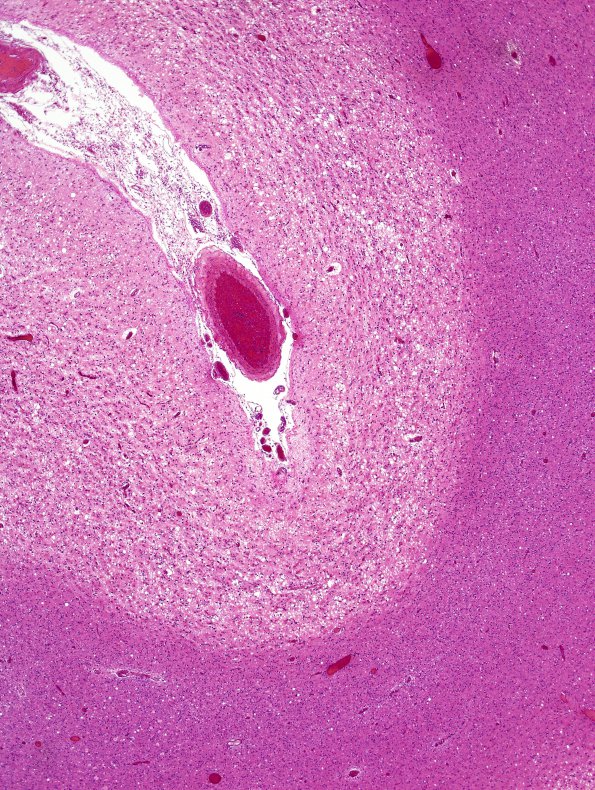 4C2 CJD, 5 yr Hx PrP proven (Case 4) H&E 6