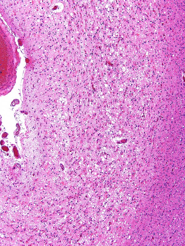 4C3 CJD, 5 yr Hx PrP proven (Case 4)