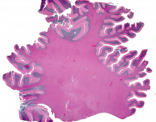 7B1 CJD (Case 7) H&E cbell 1 whole mount