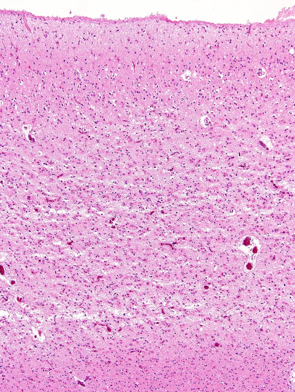 8B3 CJD, AD Balloon cells (Case 8) H&E 11