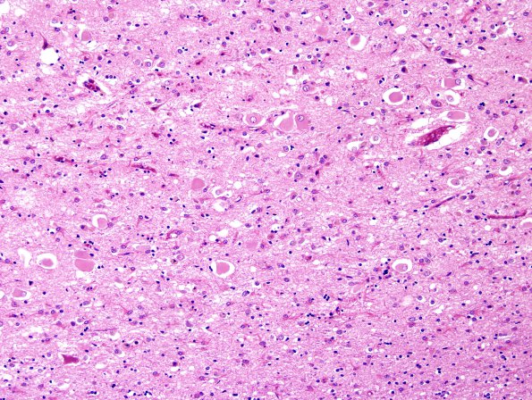 8B4 CJD, AD Balloon cells (Case 8) H&E 4