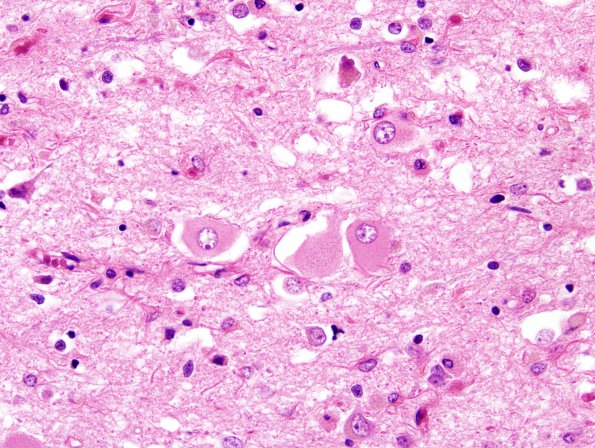 8B5 CJD, AD Balloon cells (Case 8) H&E 7