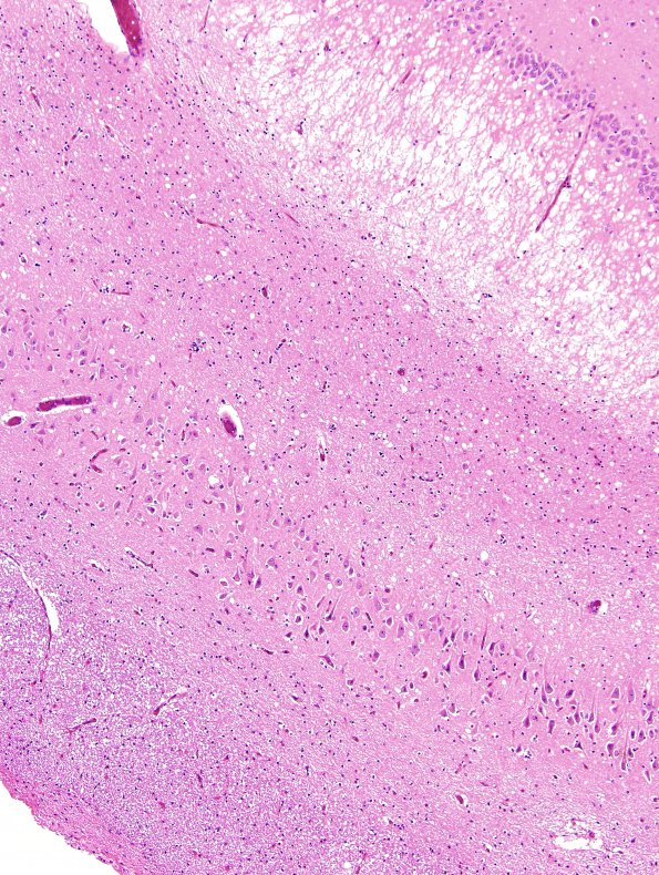 8C2 CJD (Case 8) HC H&E 5