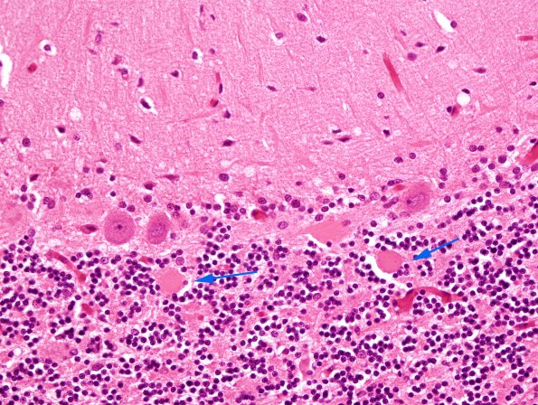 9B1 CJD, with kuru plaques (Case 9) H&E 1 copy.jpg