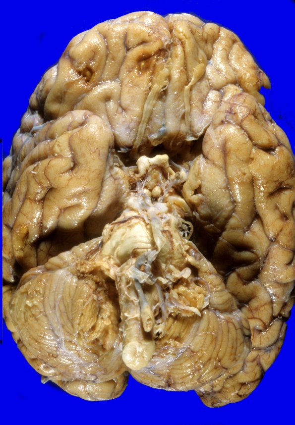 11A1 Contusion, Remote PD, roof fall (Case 11) 1