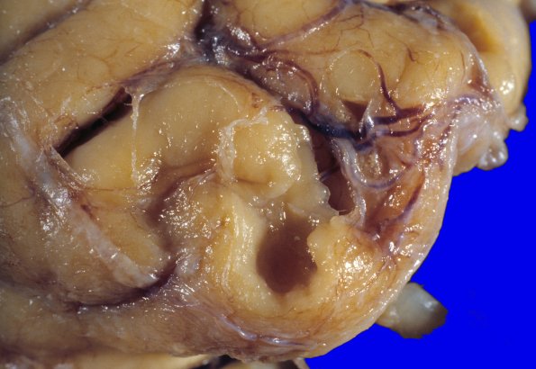 11A3 Contusion, Remote PD, roof fall (Case 11) 4