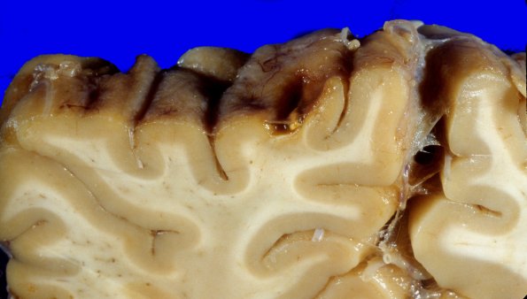 11B1 Contusion, Remote PD, roof fall (Case 11) 5