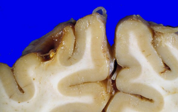 11B2 Contusion, Remote PD, roof fall (Case 11) 6