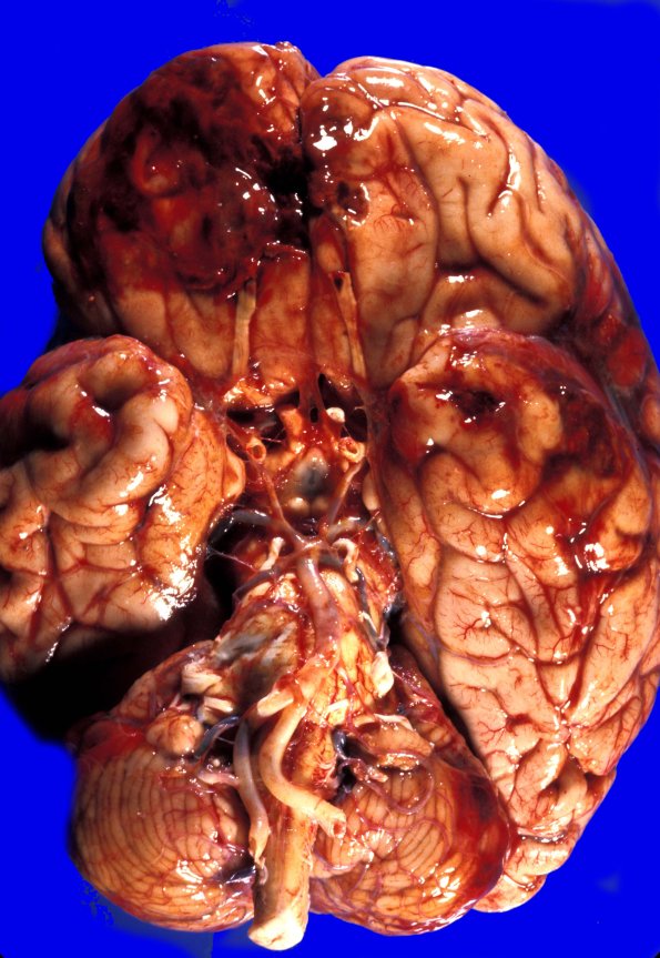 14A1 Contusion, Recent (Case 14) 1