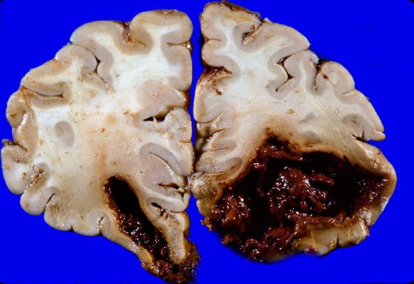 14A2 Contusion, Recent (Case 14) 2
